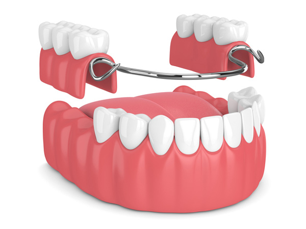 partial denture used for replace the teeth that are extracted