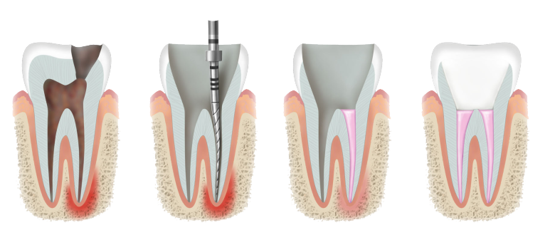 endodontically treated tooth using endodontic rotary instrument